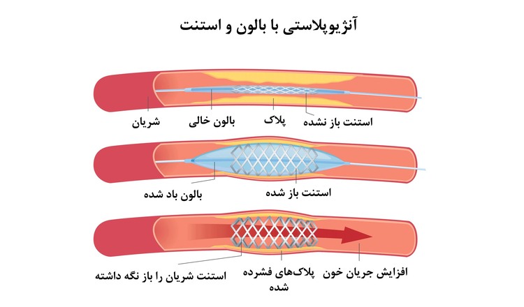 آنژیوپلاستی با استنت