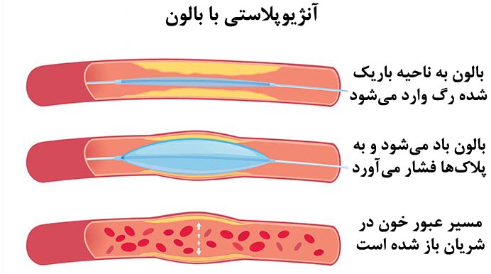 آنژیوپلاستی با بالون