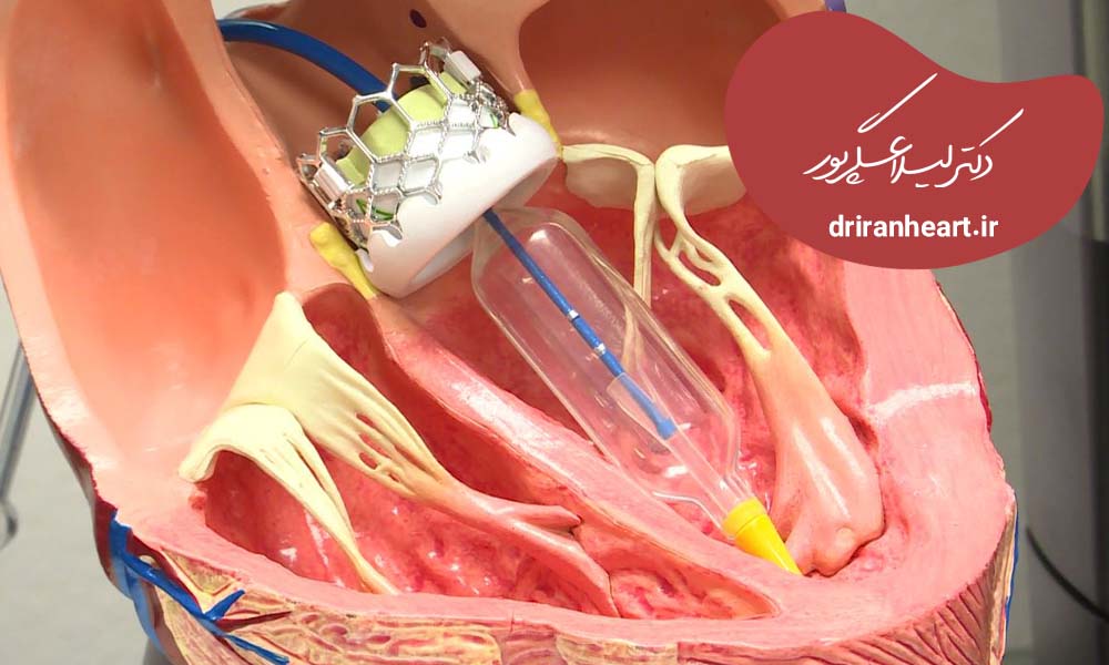 تعویض دریچه میترال در کرج