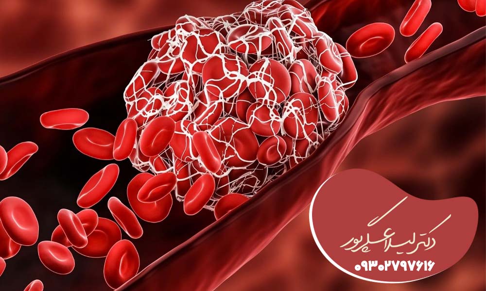 درمان فوری پلاکت خون بالا