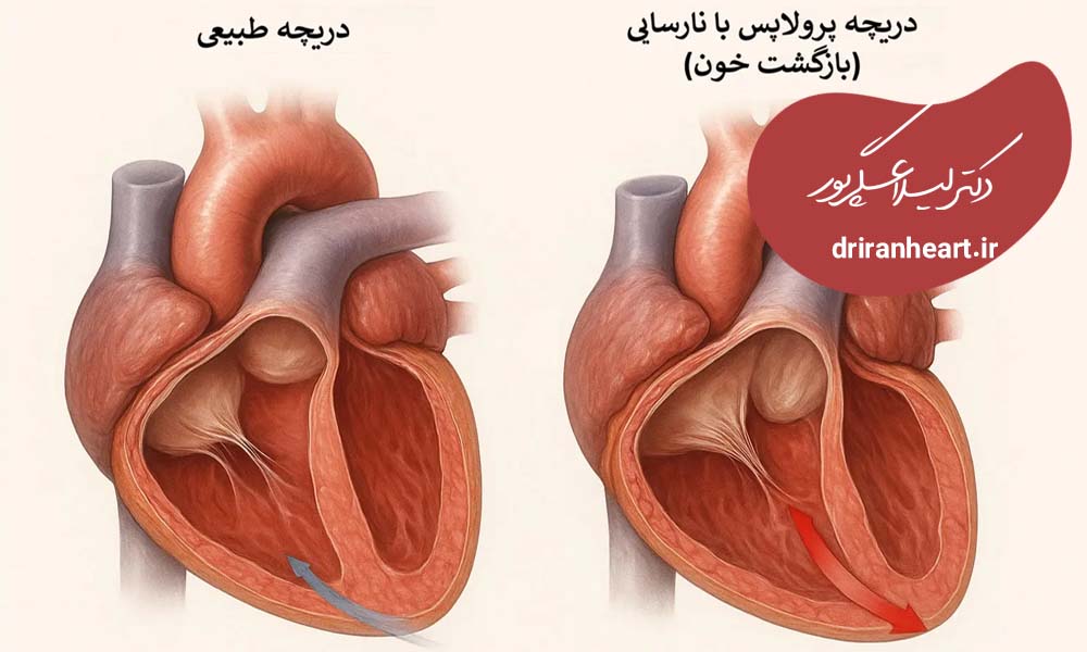 دریچه میترال قلب