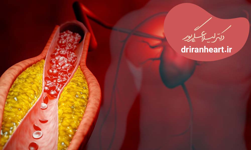 راه پیشگیری از تری گلیسیرین بالا