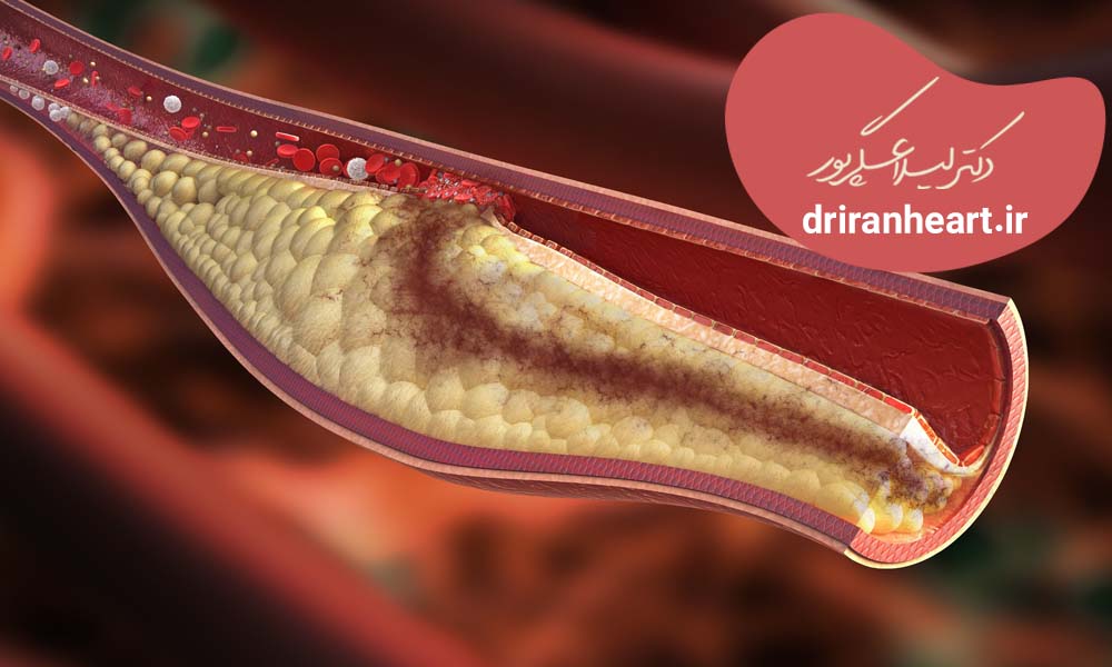 راه پیشگیری از کلسترول بالا