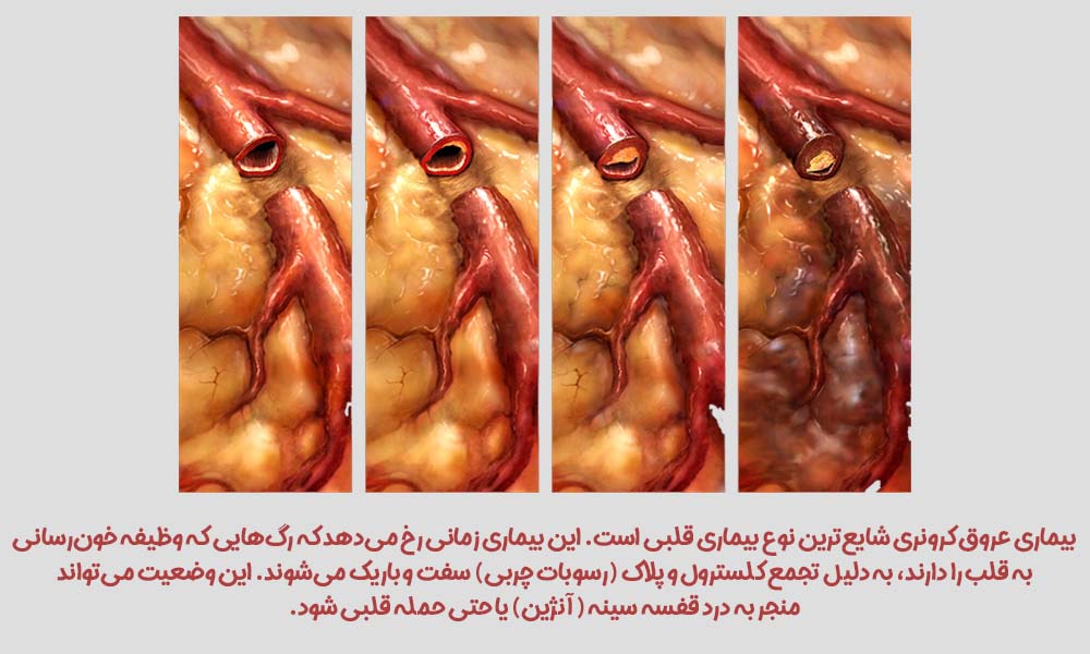 علائم حمله قلبی