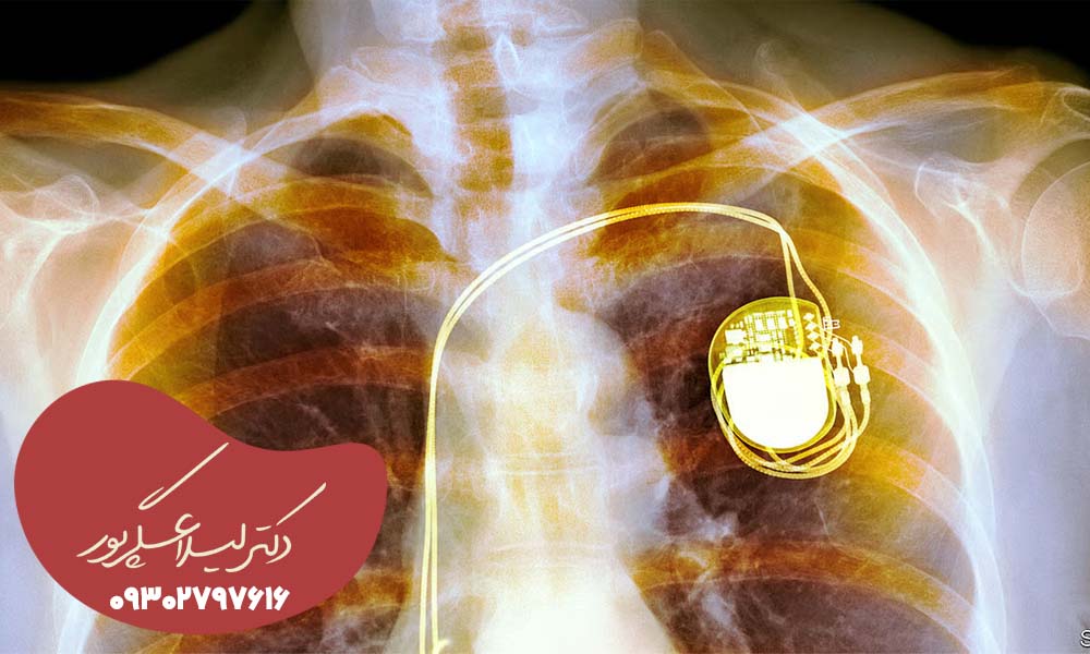 نصب باطری قلب