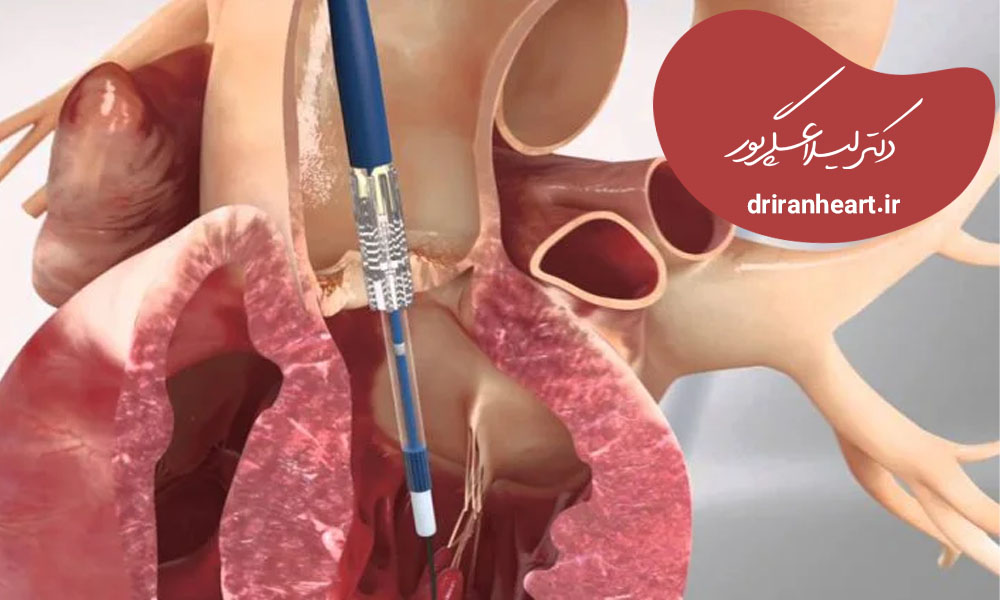 هزینه جراحی دریچه میترال قلب