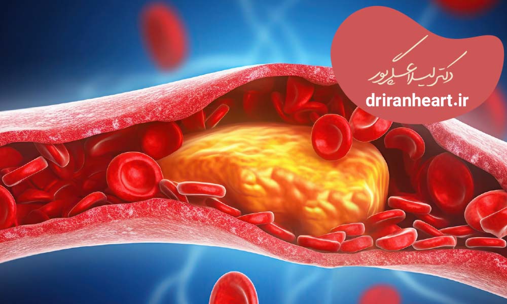 کاهش تری گلیسیرین بالا