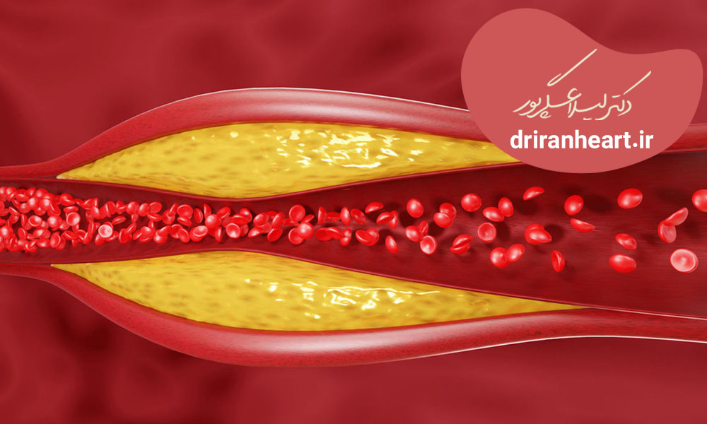 کاهش کلسترول بالا